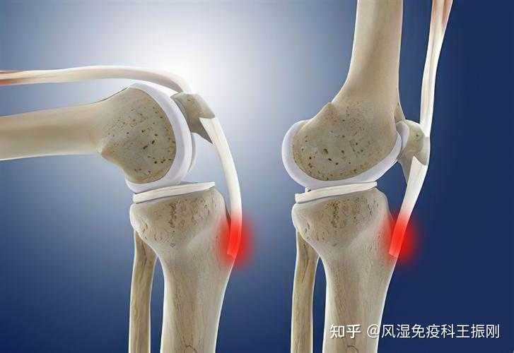 膝盖酸痛的原因（膝盖酸痛怎么解决）